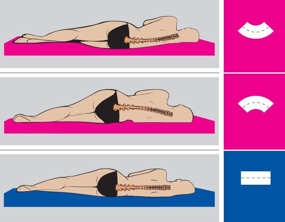 Prawidłowa pozycja ciała podczas snu z osteochondrozą lędźwiową