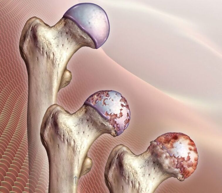 Artroza stawu biodrowego