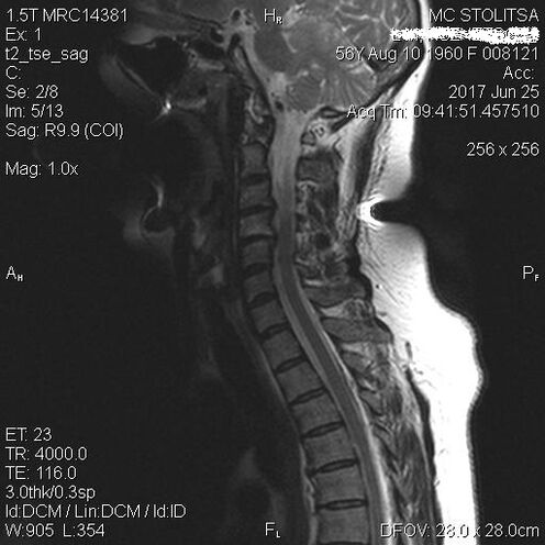 Osteochondroza i spondyloza kręgosłupa szyjnego