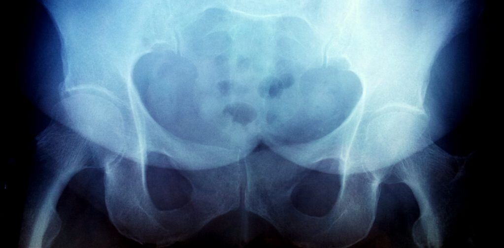 X -Ray obraz z artrozą drugiego stopnia